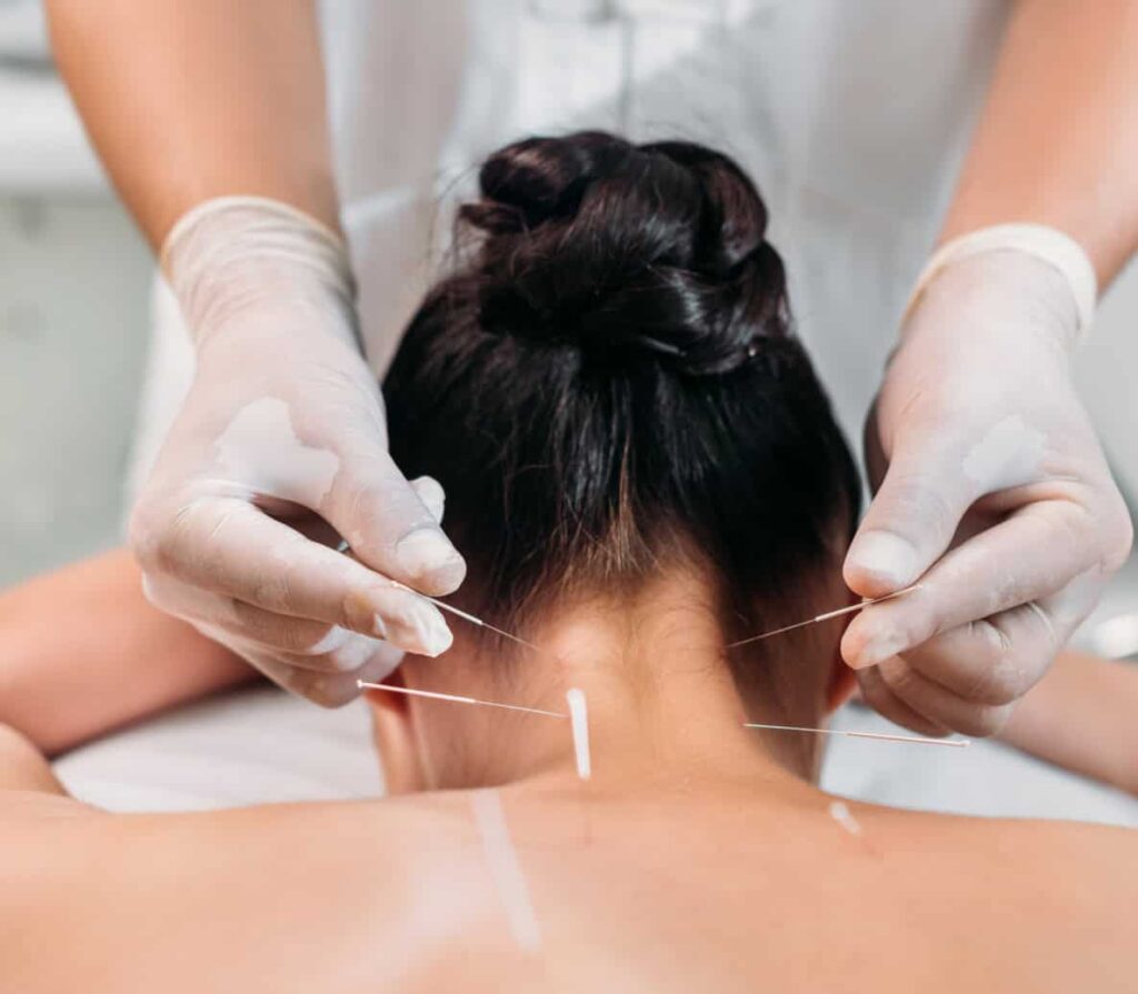 Fizjoterapia Igłoterapia